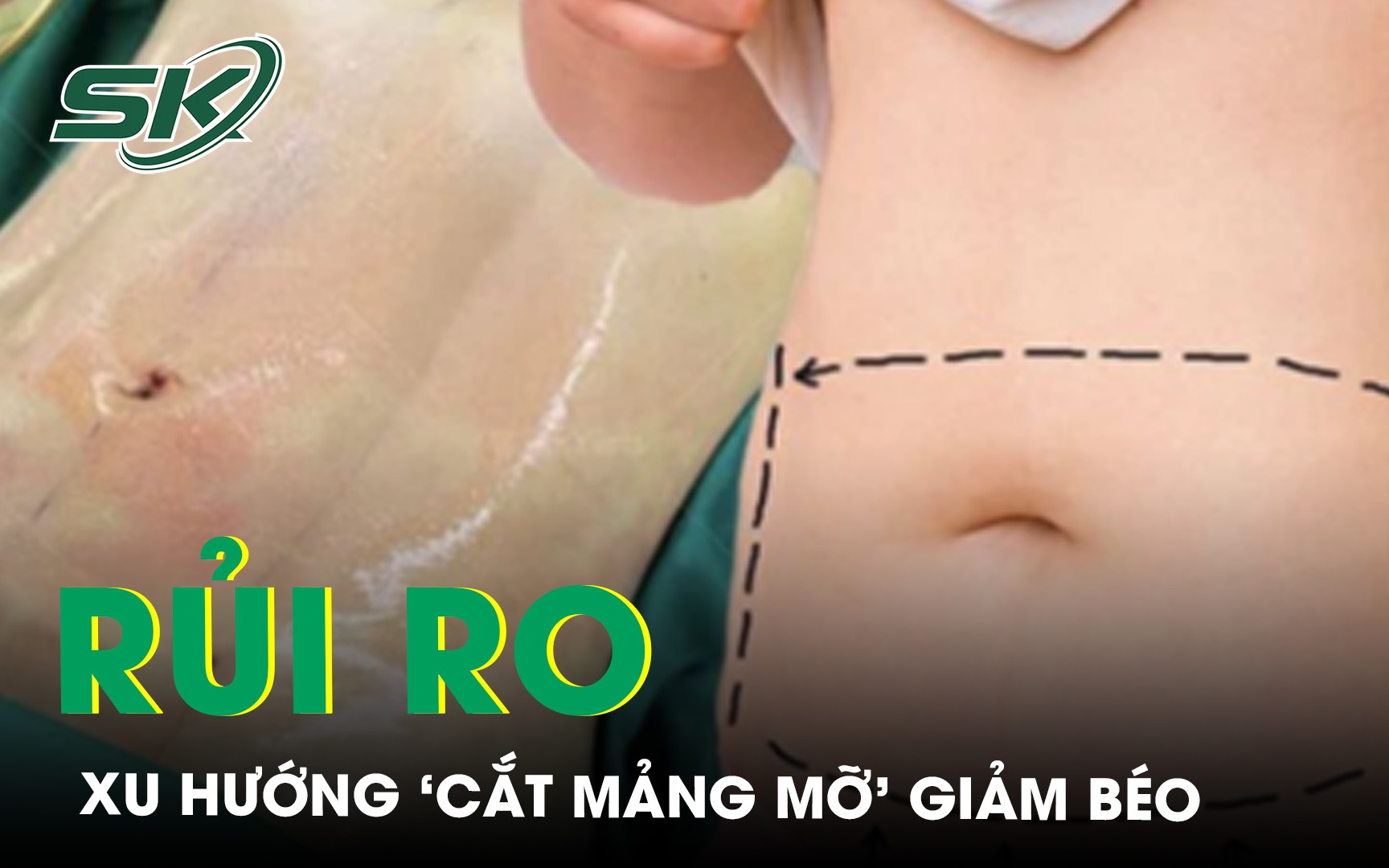 Cảnh báo quảng cáo ‘cắt mảng mỡ’ giảm béo tiềm ẩn nhiều rủi ro