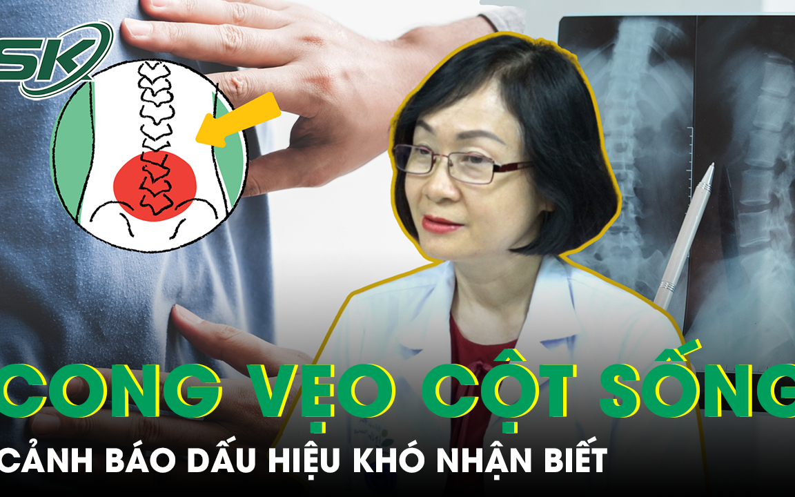 Cảnh báo những dấu hiệu cong vẹo cột sống ở trẻ cần phát hiện sớm