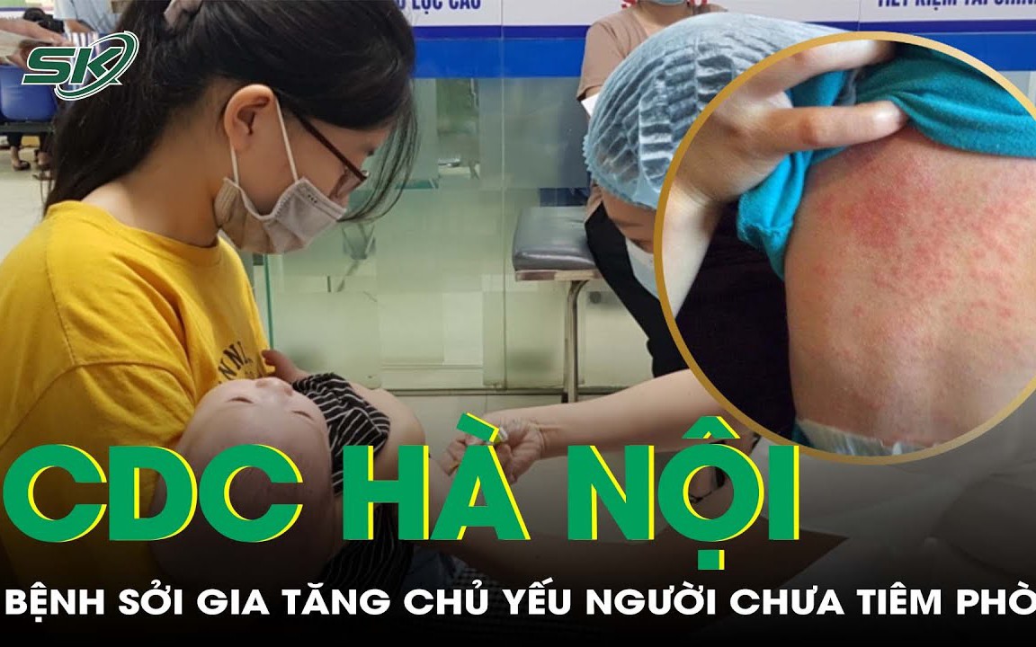 Hà Nội: Bệnh sởi có xu hướng gia tăng, chủ yếu ở người chưa tiêm vaccine