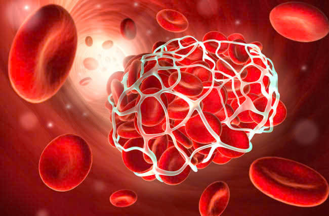 Tập luyện đúng cách ở người mắc hội chứng antiphospholipid- Ảnh 1.