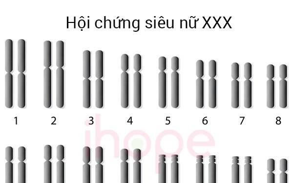 Tập vật lý trị liệu cho người mắc hội chứng siêu nữ