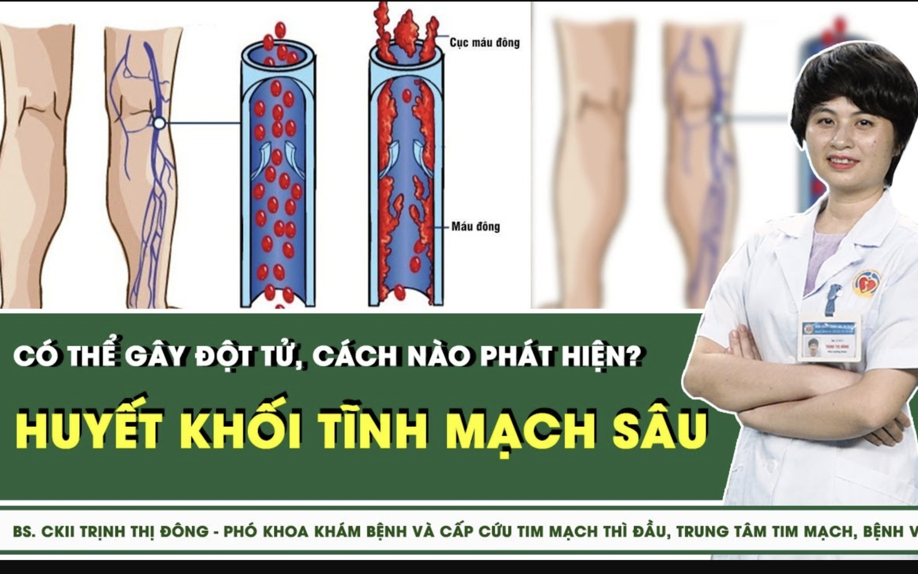 Huyết khối tĩnh mạch sâu có thể gây đột tử, cách nào phát hiện?