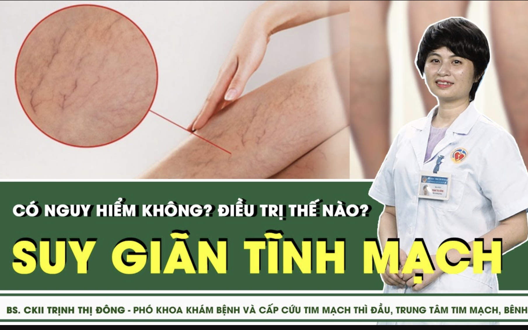 Suy giãn tĩnh mạch điều trị thế nào?