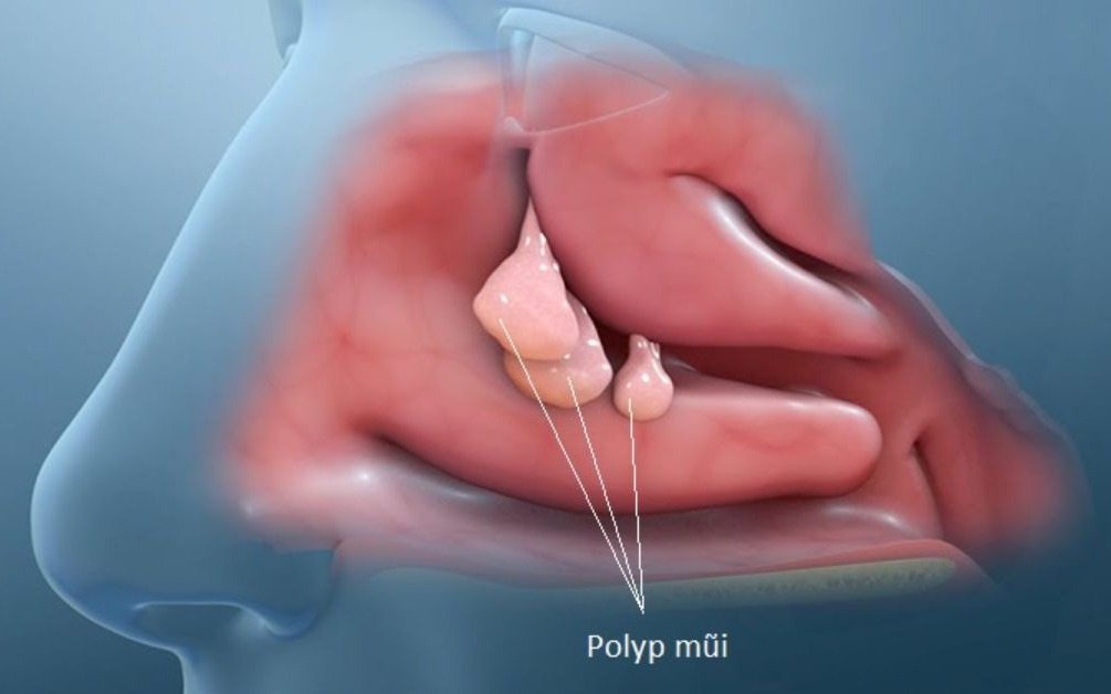 Polyp mũi: Nguyên nhân, triệu chứng, cách điều trị và phòng bệnh