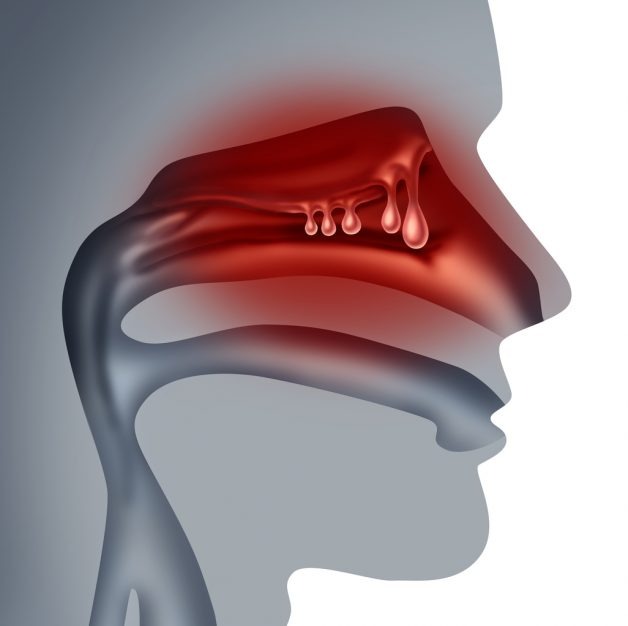 Polyp mũi: Nguyên nhân, triệu chứng, cách điều trị và phòng bệnh- Ảnh 1.