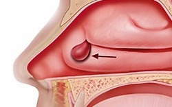 Thuốc và phương pháp điều trị polyp mũi