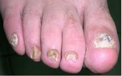 Các thuốc điều trị bệnh nấm móng