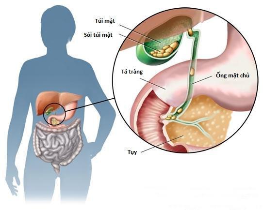 Sỏi mật khi nào cần phải mổ?- Ảnh 2.