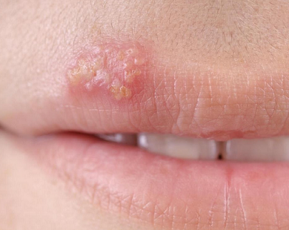 Cách phòng tránh lây nhiễm Herpes sinh dục- Ảnh 1.