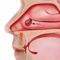 Câu hỏi thường gặp liên quan đến bệnh polyp mũi- Ảnh 1.