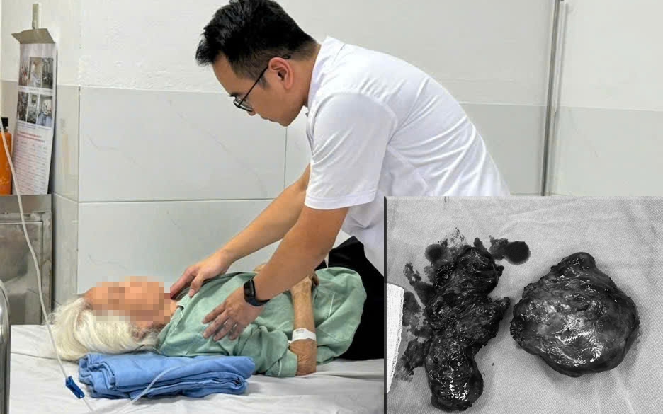 Phẫu thuật thành công bướu tuyến giáp khổng lồ thòng dưới xương đòn- Ảnh 3.