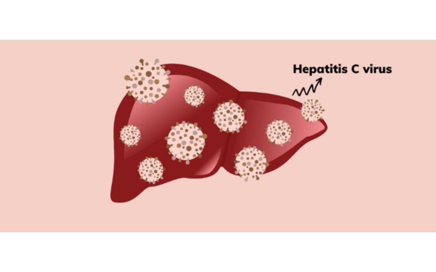 Kế hoạch điều trị viêm gan virus C ở người nhiễm HIV