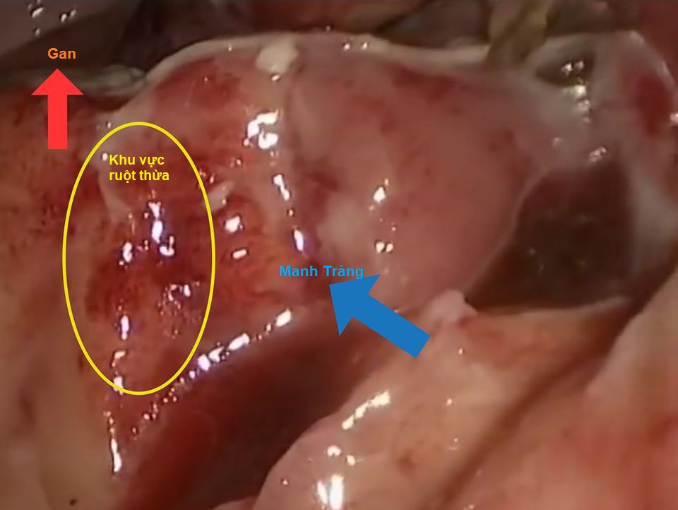 Đau bụng âm ỉ, đau bụng quanh rốn cảnh giác với viêm ruột thừa- Ảnh 2.