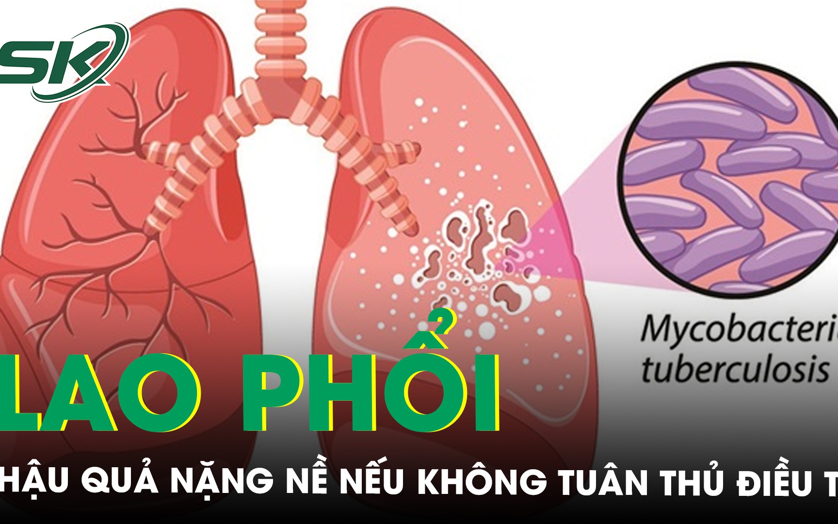 Hậu quả nặng nề nếu người bệnh lao phổi không tuân thủ điều trị