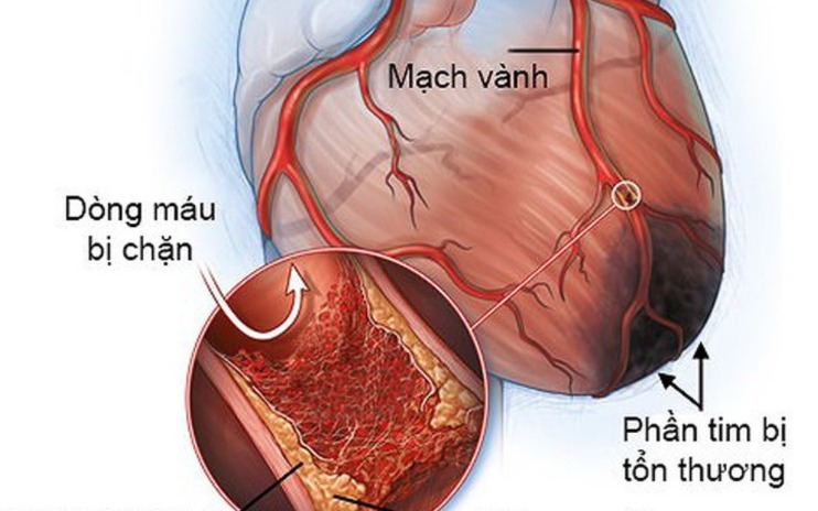 Bệnh mạch vành: Nguyên nhân, triệu chứng, cách điều trị và phòng bệnh