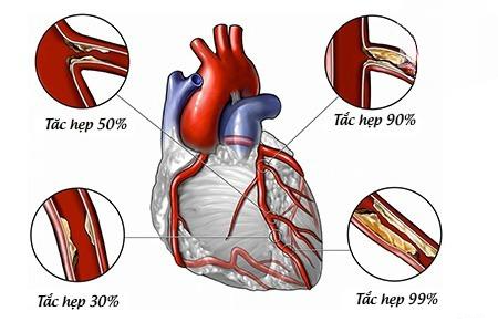 Bệnh mạch vành: Nguyên nhân, triệu chứng, cách điều trị và phòng bệnh- Ảnh 1.