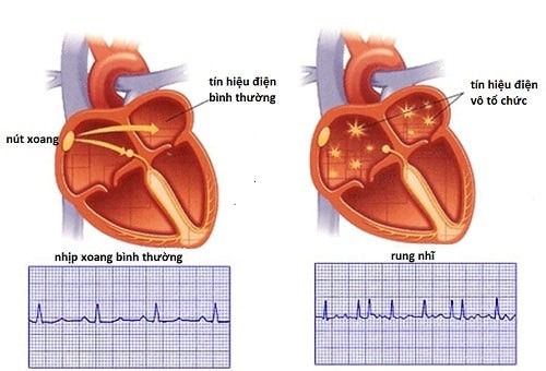 Ngoại tâm thu: Nguyên nhân, triệu chứng, cách điều trị và phòng bệnh- Ảnh 3.