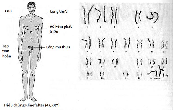 Hội chứng XYY có chữa được không?- Ảnh 1.