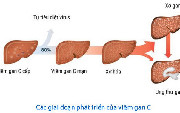 Gỡ rào cản sàng lọc và điều trị để tiến tới loại trừ viêm gan virus vào năm 2030 - Ảnh 3.