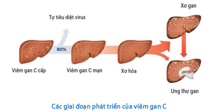 Cần làm gì để triển khai Kế hoạch điều trị viêm gan virus C ở người nhiễm HIV?- Ảnh 2.