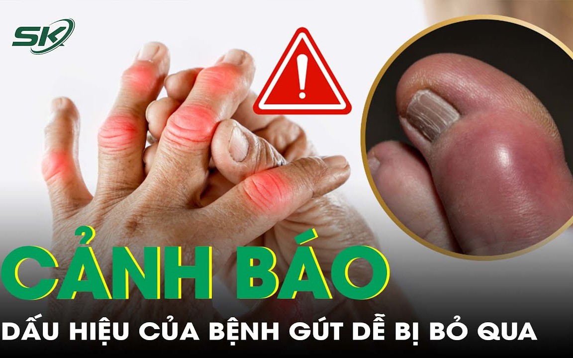 Dấu hiệu nguy hiểm cảnh báo bệnh gút dễ bị bỏ qua