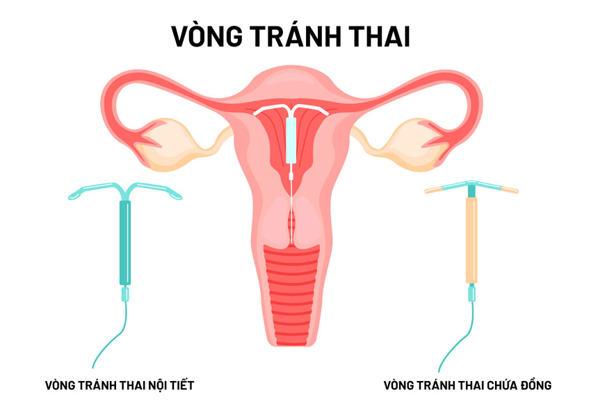CHI PHÍ ĐẶT VÒNG TRÁNH THAI NỘI TIẾT MIRENA BAO GỒM GIÁ VÒNG VÀ DỊCH VỤ KHÁM ĐẶT TẠI CƠ SỞ Y TẾ