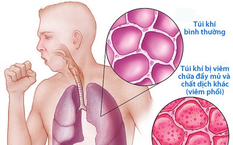 Phòng viêm phổi mùa lạnh với 4 nguyên tắc sau