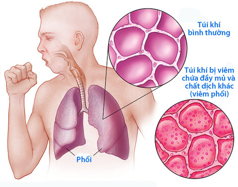 Phòng viêm phổi mùa lạnh với 4 nguyên tắc sau- Ảnh 1.