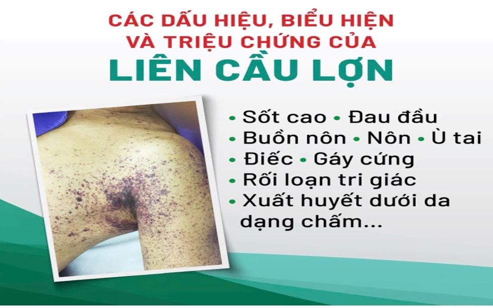 Sốt cao, đau nhức cơ, đi khám phát hiện mắc liên cầu lợn