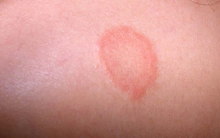 Bệnh lác đồng tiền là bệnh gì và cách điều trị, dự phòng 