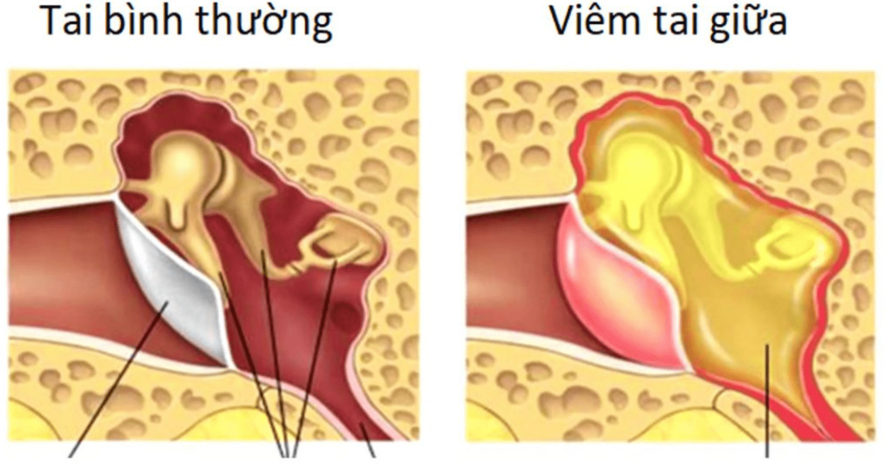 Người bệnh viêm tai giữa tập luyện như thế nào?- Ảnh 1.