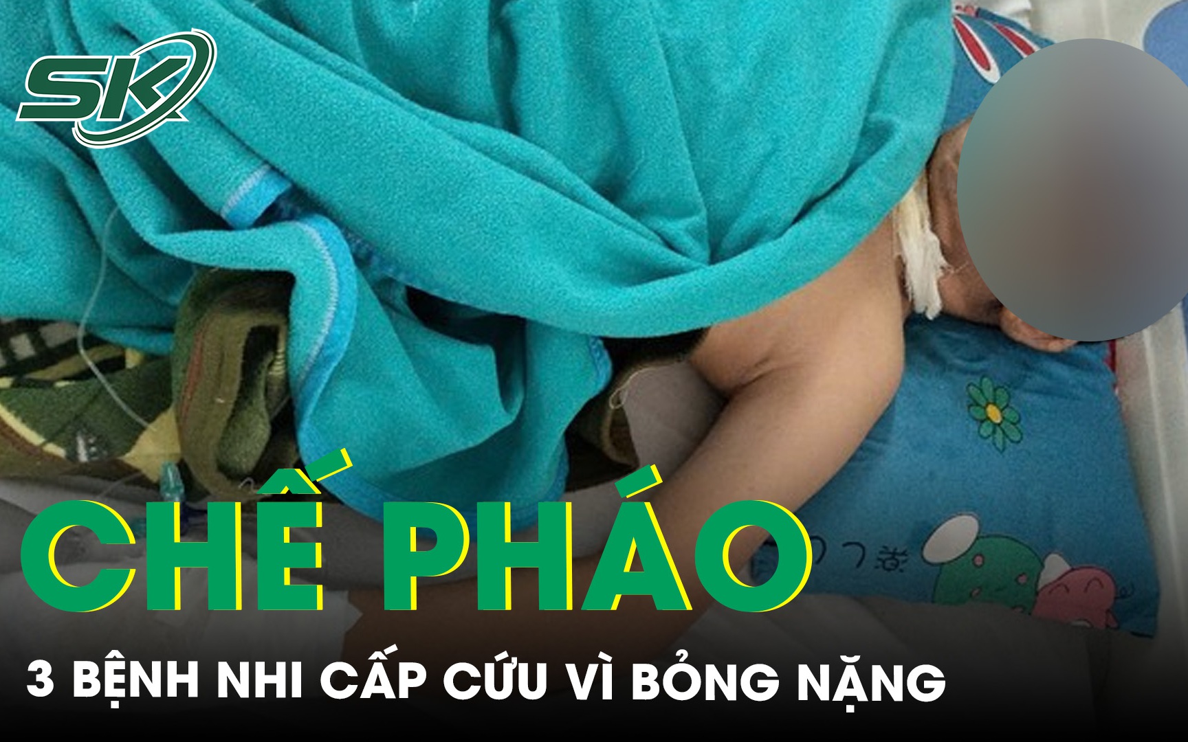 Tự mua thuốc nổ trên mạng về chế pháo, 3 bệnh nhi bỏng nặng