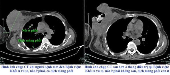 Khối u ngày càng to, lở loét do tự điều trị ung thư vú bằng đắp thuốc nam- Ảnh 1.