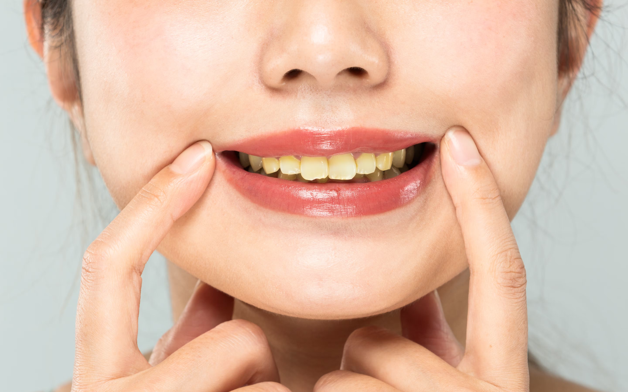 4 hệ luỵ nếu tẩy trắng răng sai cách- Ảnh 2.