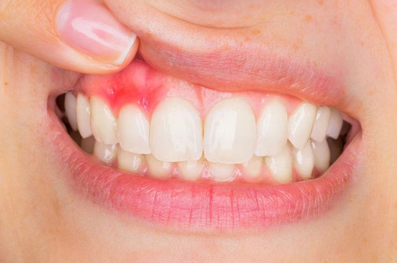 Viêm lợi sau khi bọc răng sứ phải làm gì?- Ảnh 2.