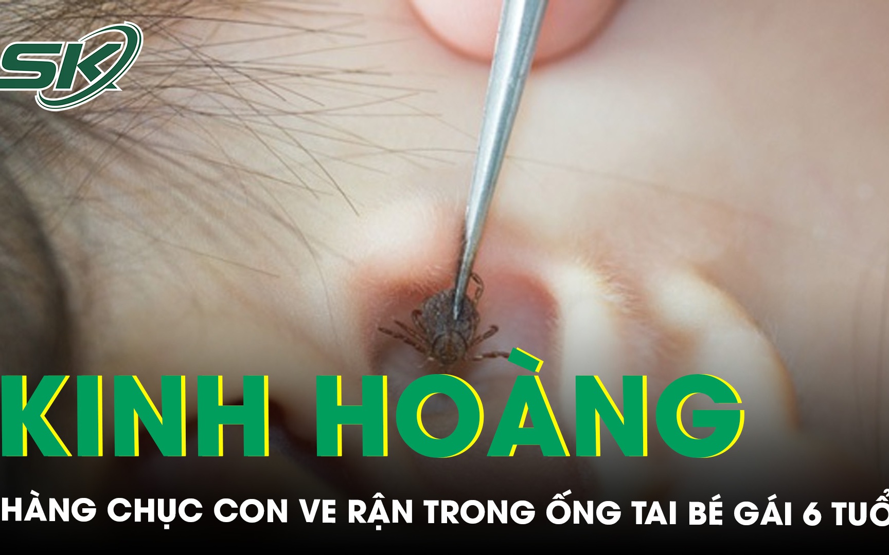 Kinh hoàng hàng chục con ve rận trong ống tai bé gái 6 tuổi