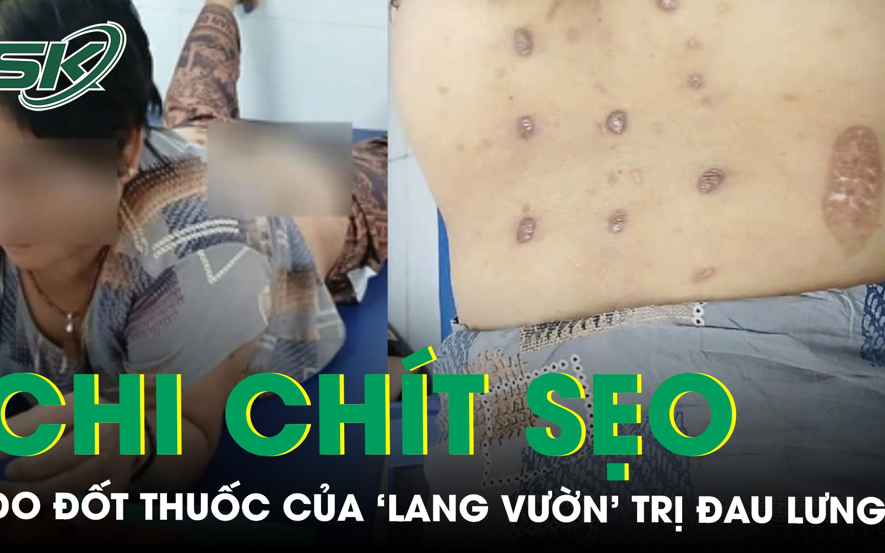 Đốt thuốc của ‘lang vườn’ trị đau lưng, bệnh không khỏi mà lưng chi chít sẹo