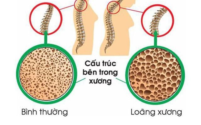 Mối nguy hiểm tiềm ẩn khi phụ nữ thiếu canxi