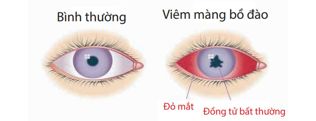 Mắt đỏ cảnh báo mắc bệnh gì, có phòng ngừa được không?- Ảnh 1.