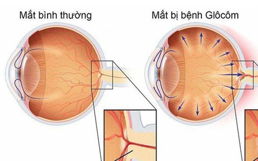 Mắt đỏ cảnh báo mắc bệnh gì, có phòng ngừa được không?