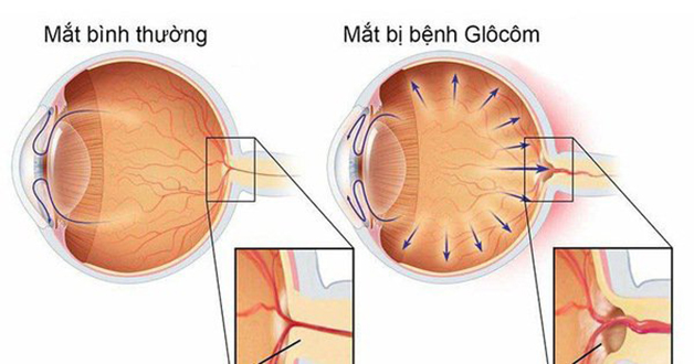 Mắt đỏ cảnh báo mắc bệnh gì, có phòng ngừa được không?- Ảnh 2.