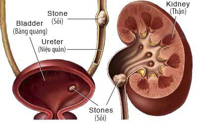 Đau hố thắt lưng kèm tiểu buốt, tiểu máu đề phòng sỏi thận, sỏi niệu quản