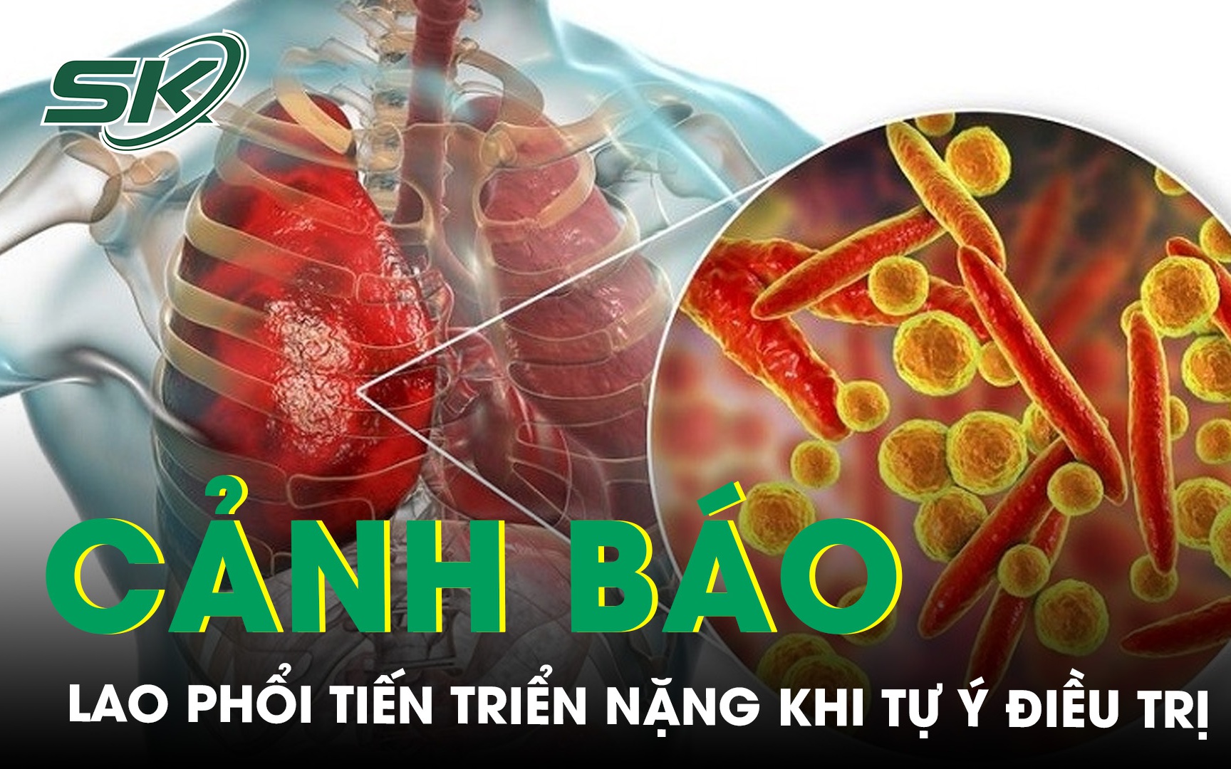 Cảnh báo nguy cơ lao phổi tiến triển nặng khi tự ý điều trị 