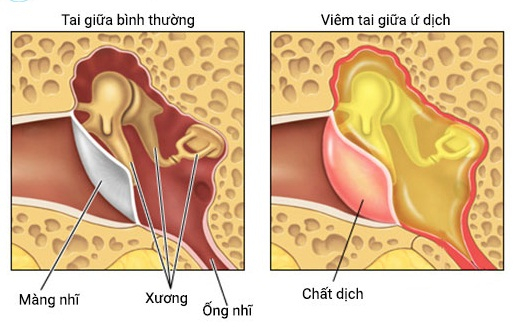 Nguyên nhân viên tai gây ứ dịch chủ yếu là do khối VA quá phát bít tắc, chèn ép vào lỗ vòi tai, gây tắc vòi tai.