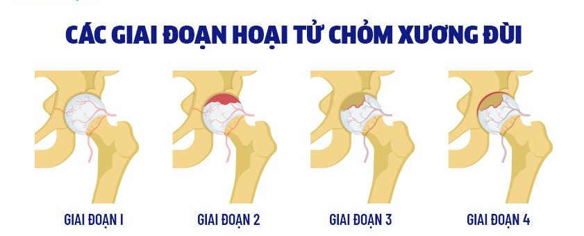 Bài tập nào tốt cho người hoại tử chỏm xương đùi?- Ảnh 1.