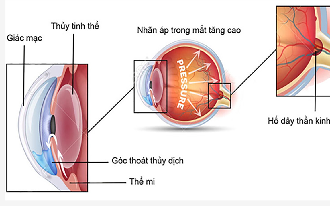Khám Phá Tác Động Của Vitamin B3 Đối Với Nguy Cơ Glôcôm
