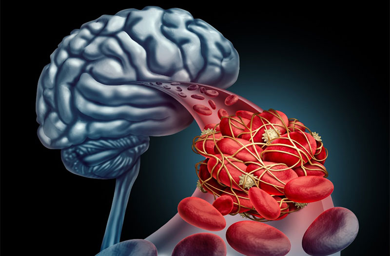 Tắc mạch máu não ai có nguy cơ mắc?- Ảnh 2.