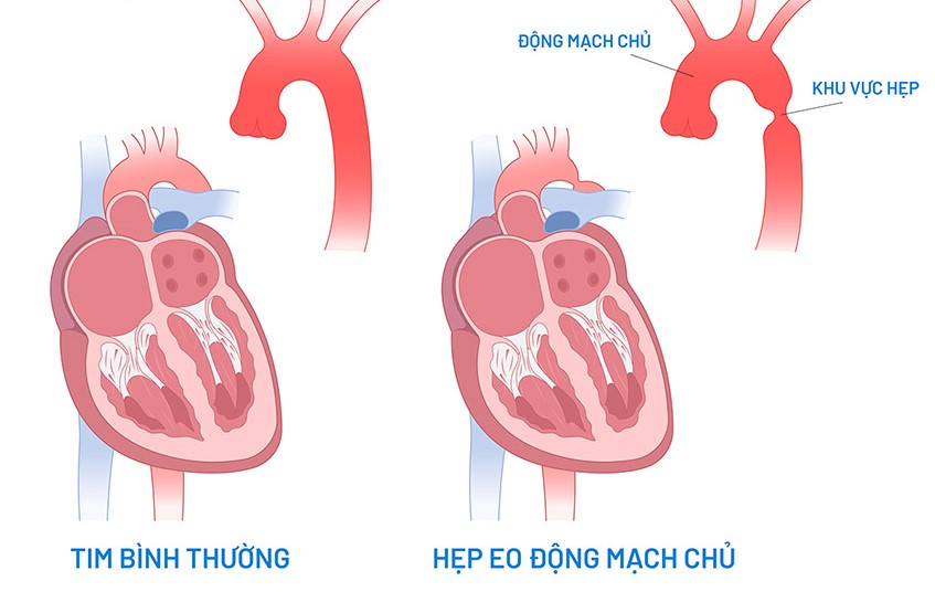 Điều trị hẹp eo động mạch chủ như thế nào?- Ảnh 1.