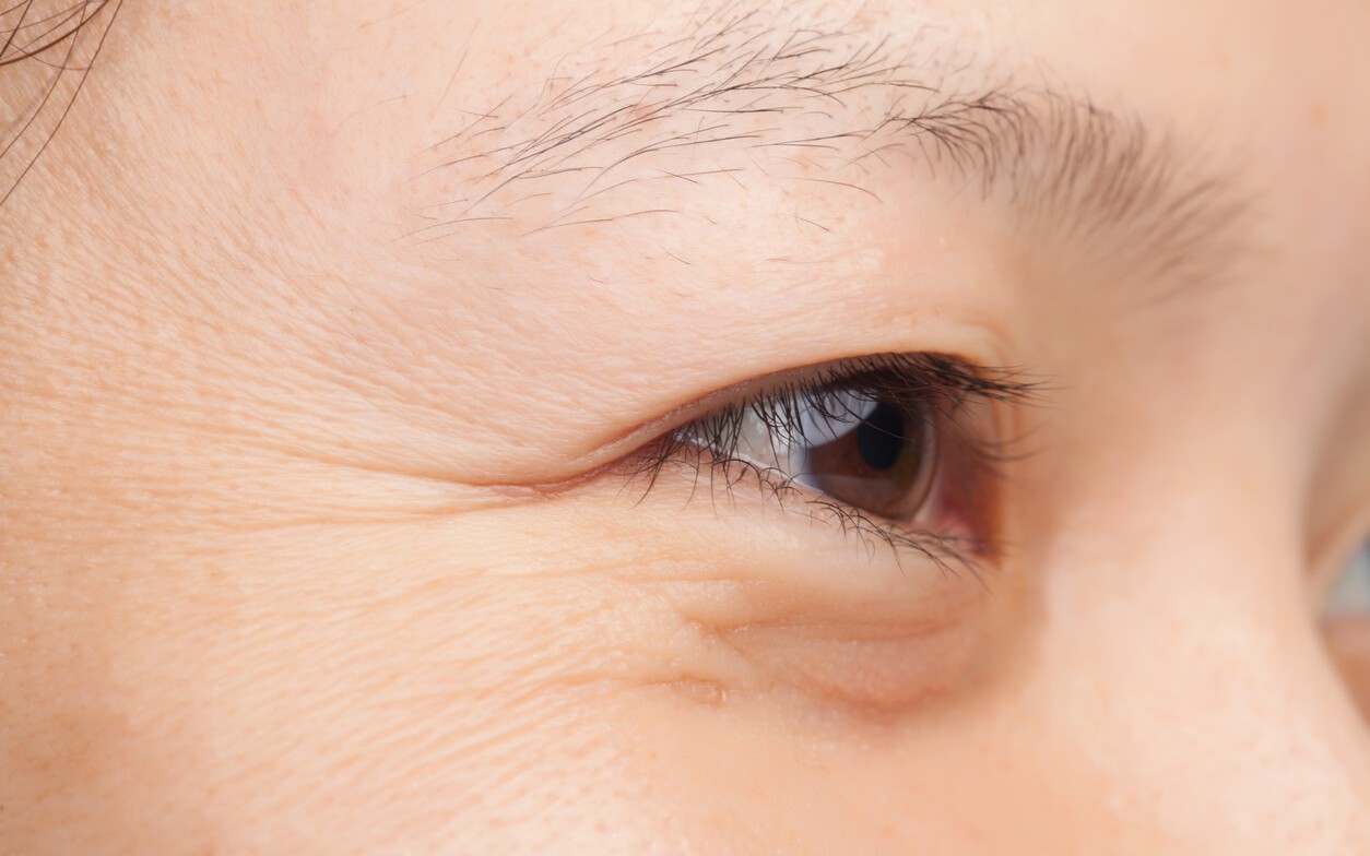 Bác sĩ khuyến cáo cách giảm nếp nhăn trên mặt hiệu quả