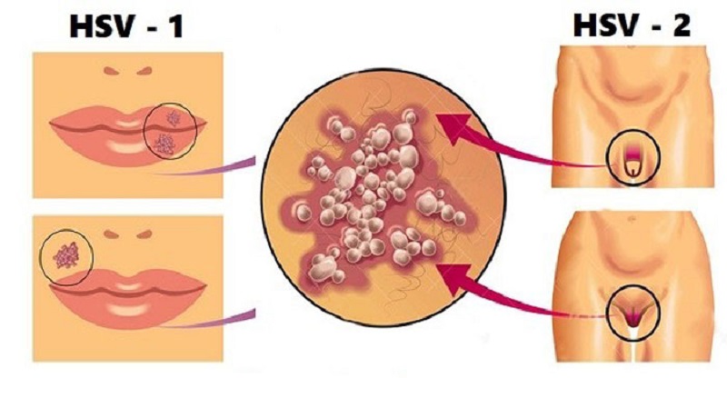 Triệu chứng bệnh mụn rộp sinh dục ở nữ